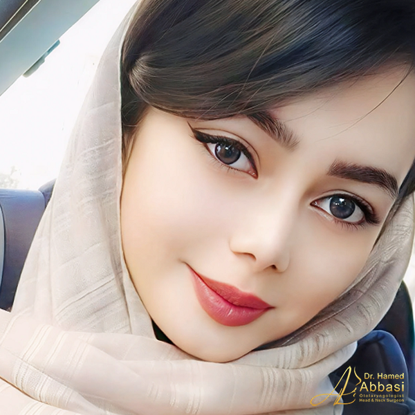 Dr. Abbasi’s Rhinoplasty Portfolio