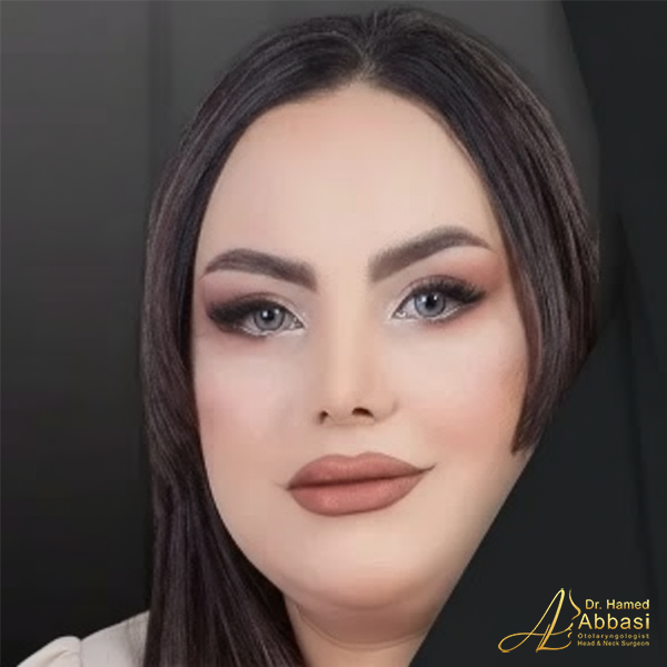 Dr. Abbasi’s Rhinoplasty Portfolio