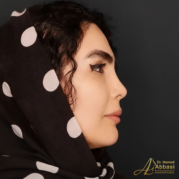 Nose Surgery by Dr. Hamed Abbasi