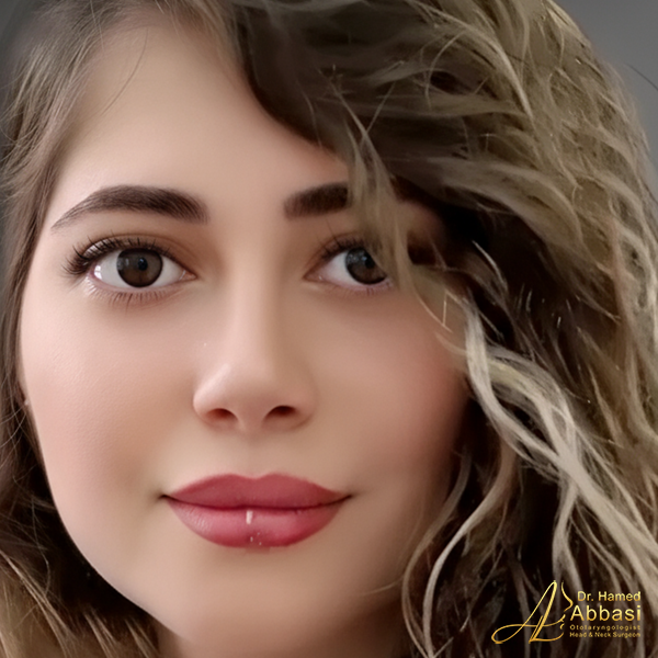 Dr. Abbasi’s Rhinoplasty Portfolio