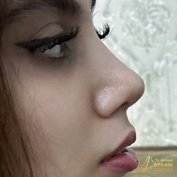 Dr. Abbasi’s Rhinoplasty Portfolio