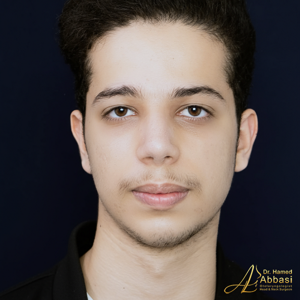 Nose Surgery by Dr. Hamed Abbasi