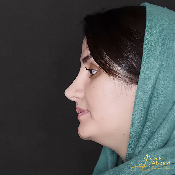 Dr. Abbasi’s Rhinoplasty Portfolio