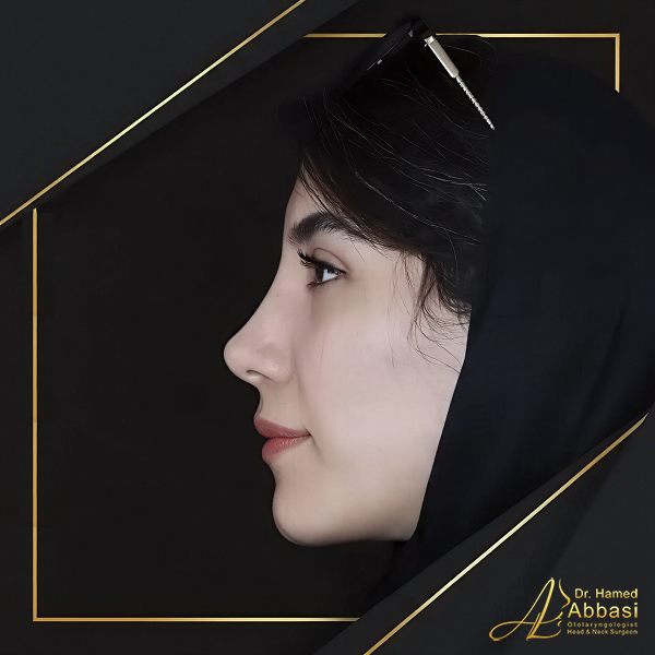 Dr. Abbasi’s Rhinoplasty Portfolio