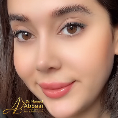 Nose Surgery Photos by Dr. Abbasi