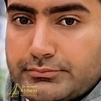 Nose Surgery Photos by Dr. Abbasi