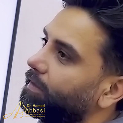 Nose Surgery Photos by Dr. Abbasi