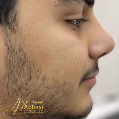 Nose Surgery Photos by Dr. Abbasi