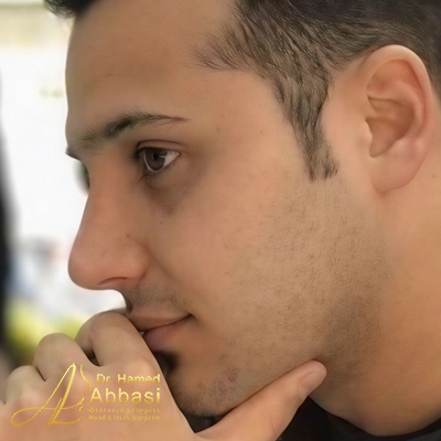 Nose Surgery Photos by Dr. Abbasi