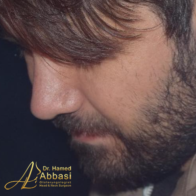 Nose Surgery Photos by Dr. Abbasi