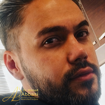 Nose Surgery Photos by Dr. Abbasi