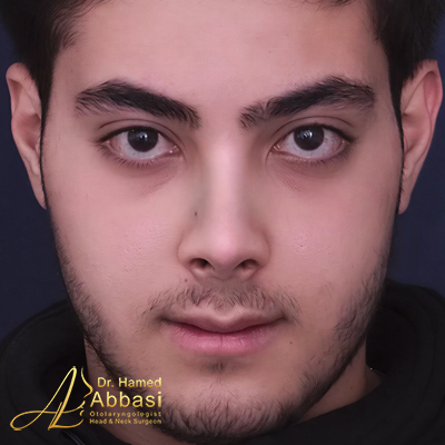 Nose Surgery Photos by Dr. Abbasi